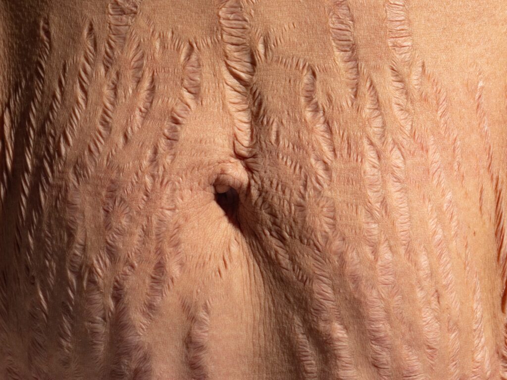 Ngoài mang thai, đâu là nguyên nhân gây rạn da?