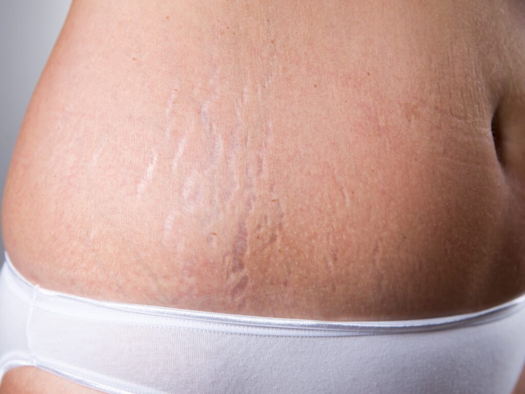 Điều trị rạn da bằng kem bôi tại nhà