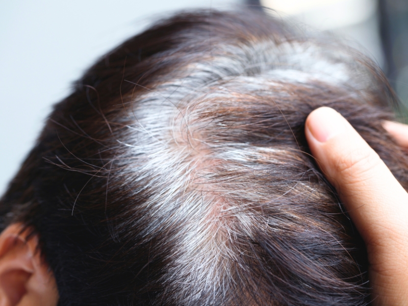 6 nguyên nhân dẫn đến hiện tượng tóc bạc sớm và cách khắc phục tốt nhất 2025